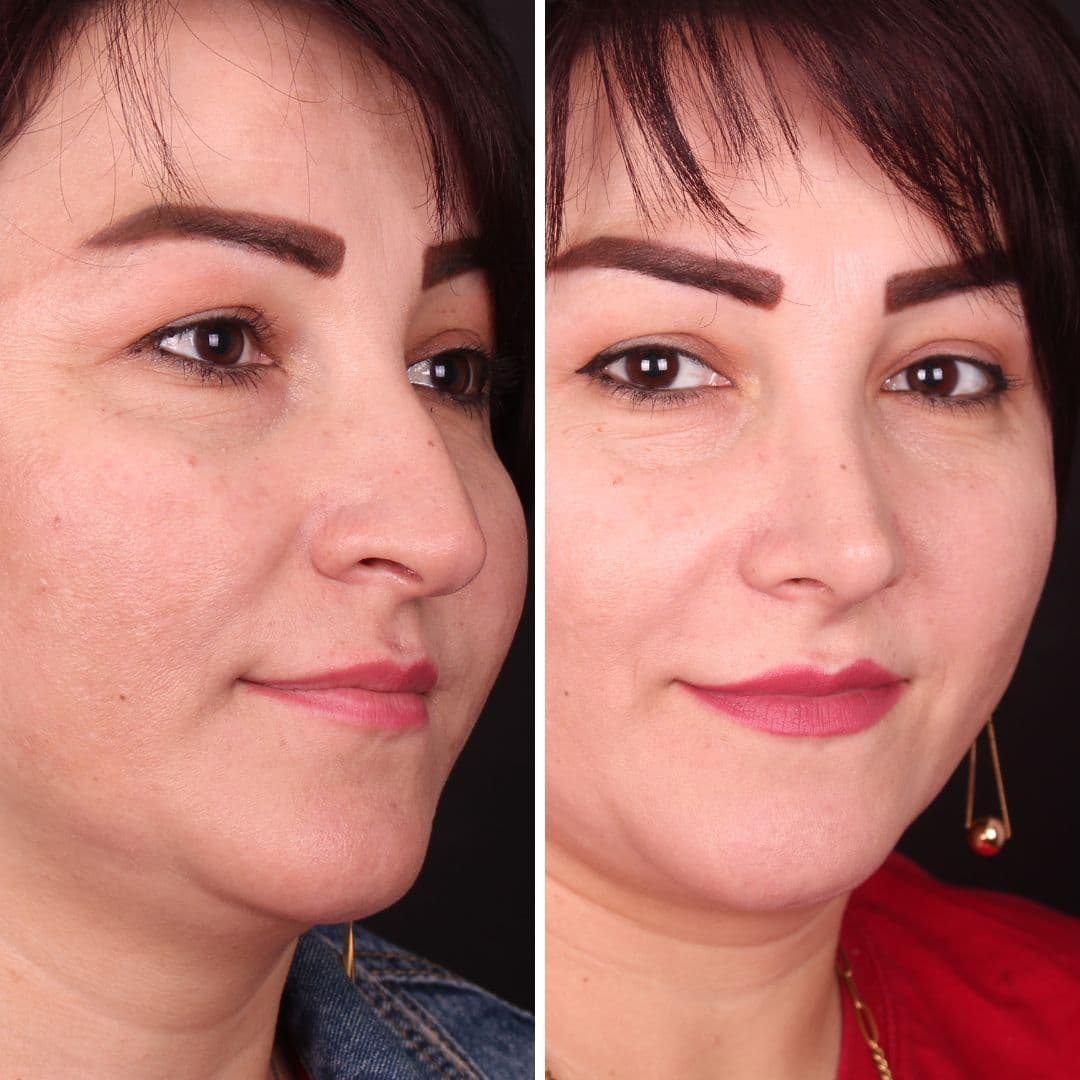 Əməliyyat əvvəli və sonrası