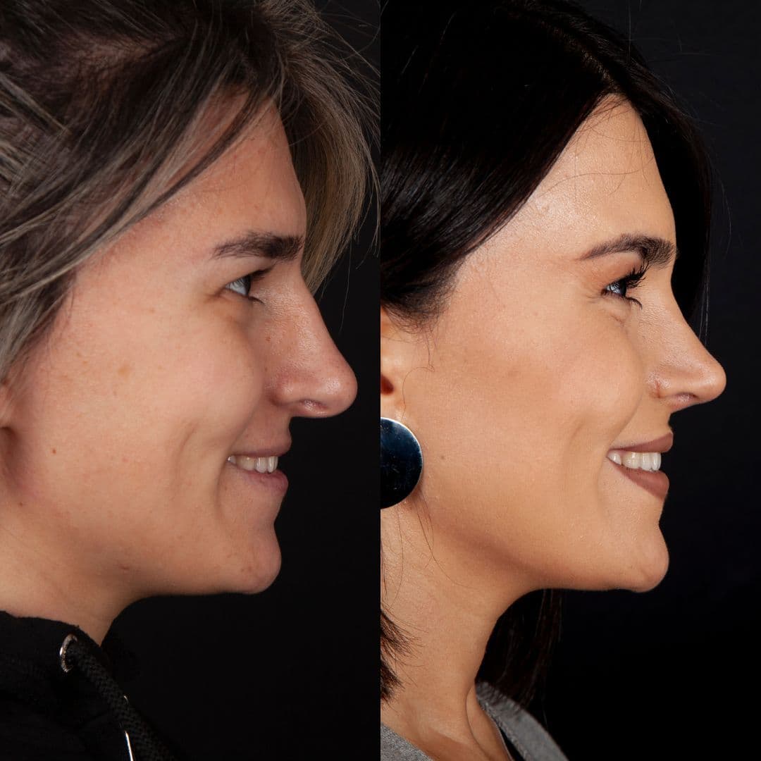 Əməliyyat əvvəli və sonrası