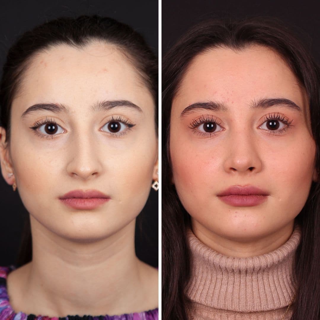 Əməliyyat əvvəli və sonrası