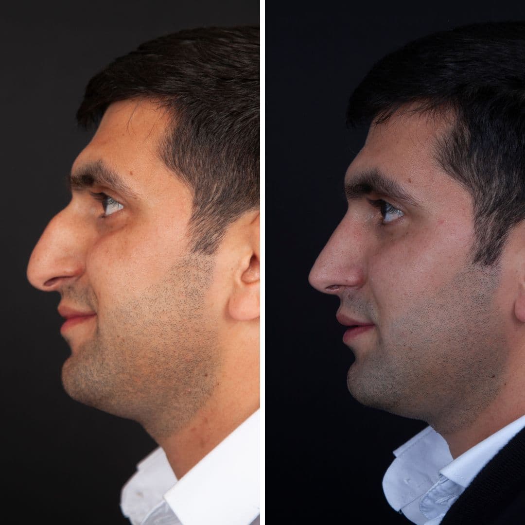 Əməliyyat əvvəli və sonrası