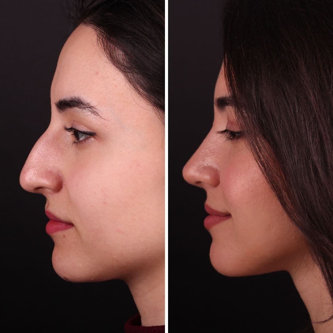 Əməliyyat əvvəli və sonrası