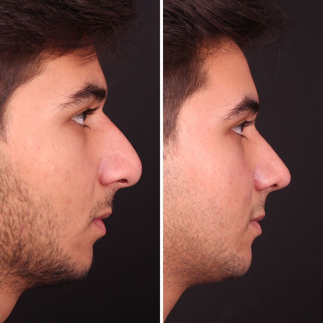 Əməliyyat əvvəli və sonrası