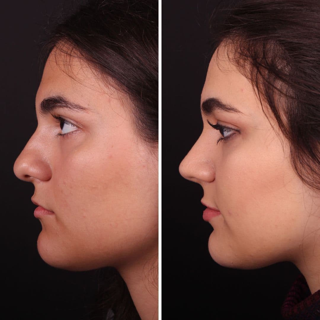 Əməliyyat əvvəli və sonrası